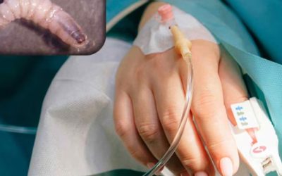 Casos de miasis en humanos por gusano barrenador aumentan a 141